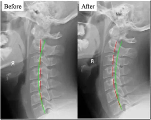 Appareil de traction cervicale avec chaleur apaisante et soutien