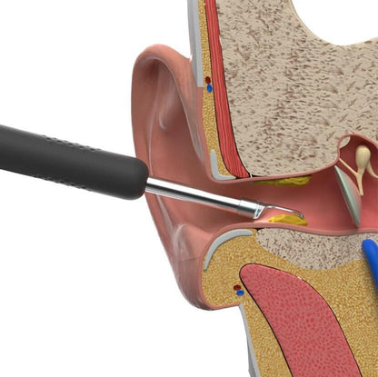 OtoClear™ Otoscope d'Elimination du Cérumen Oreille Intelligent